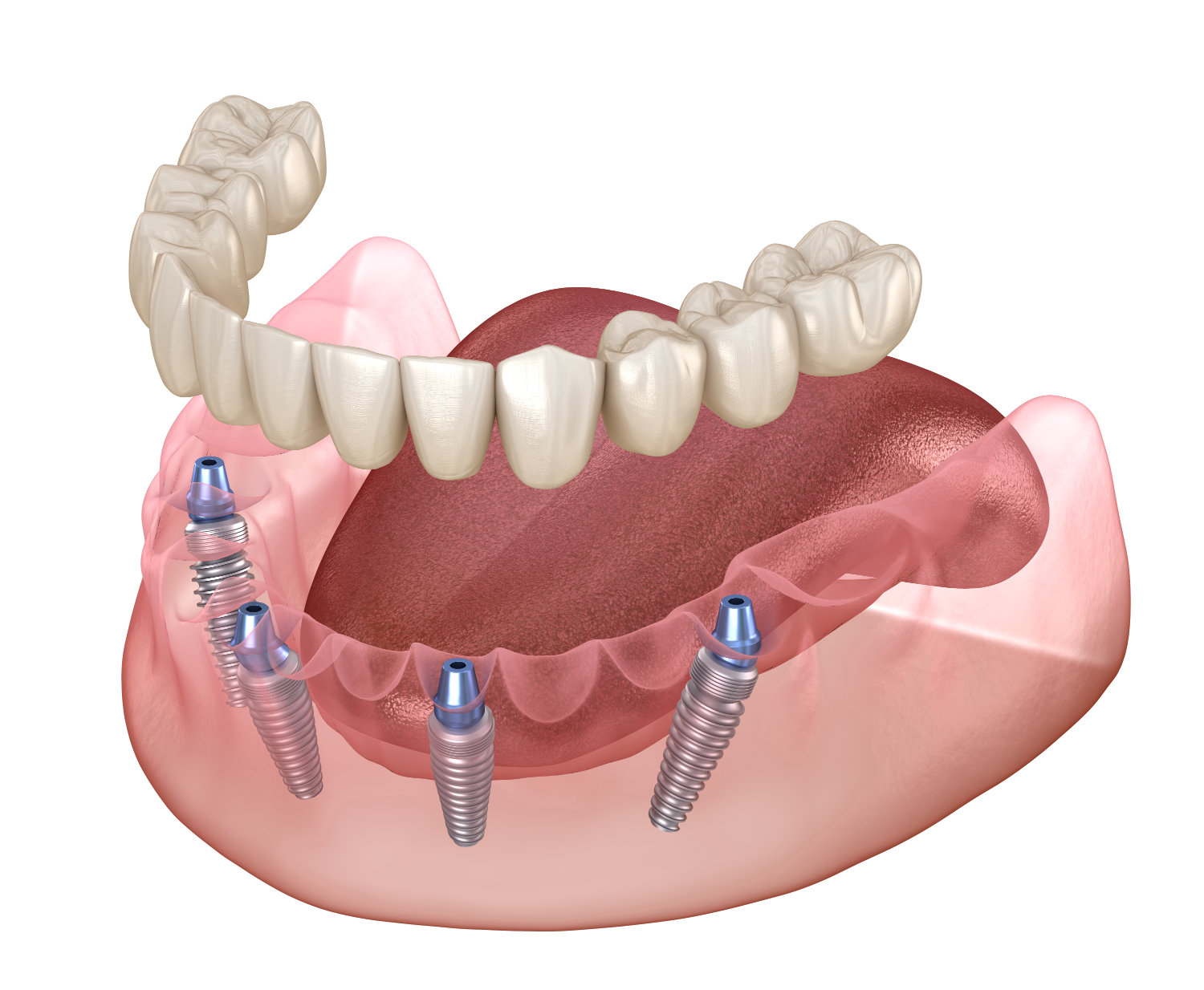 All-on-4 Implantate