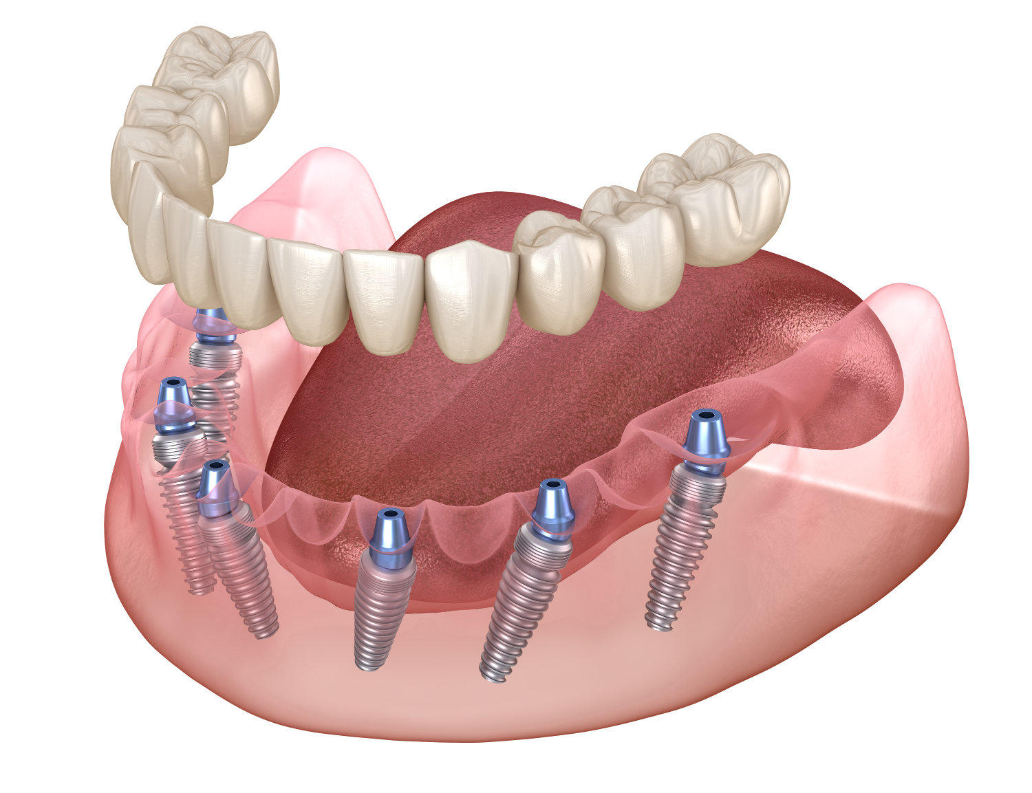 All-on-6 Implantat